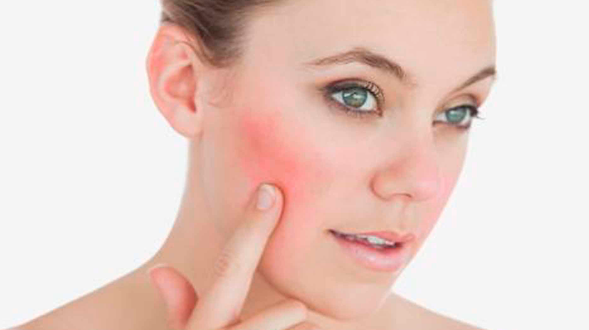 Cómo tratar naturalmente la piel con acné