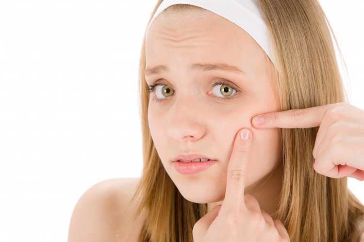 ¿Por qué aparece el acné en la adolescencia?