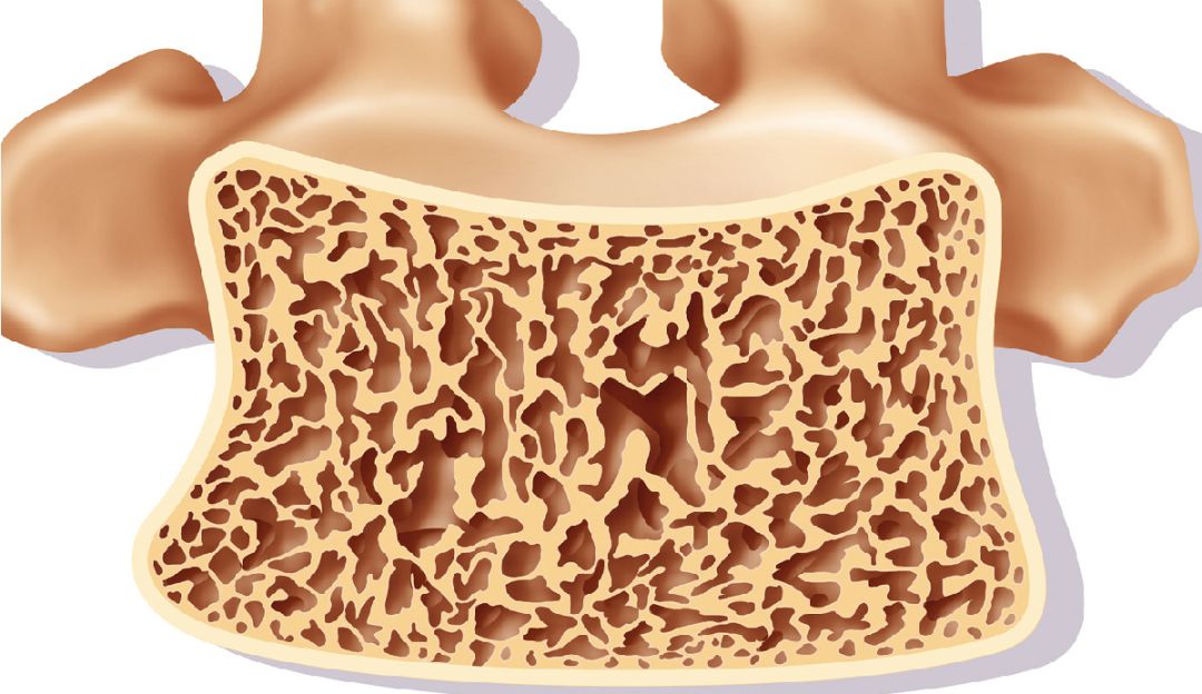 Cambios de alimentación para tu osteoartritis