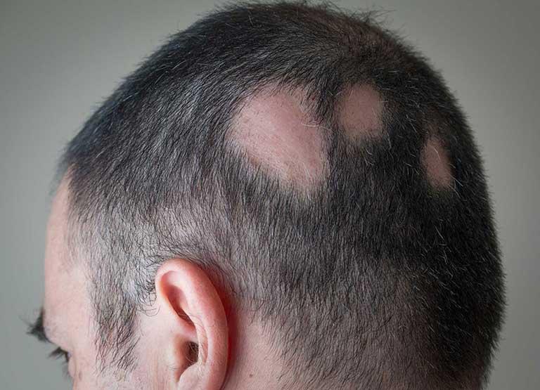 alopecia en hombres