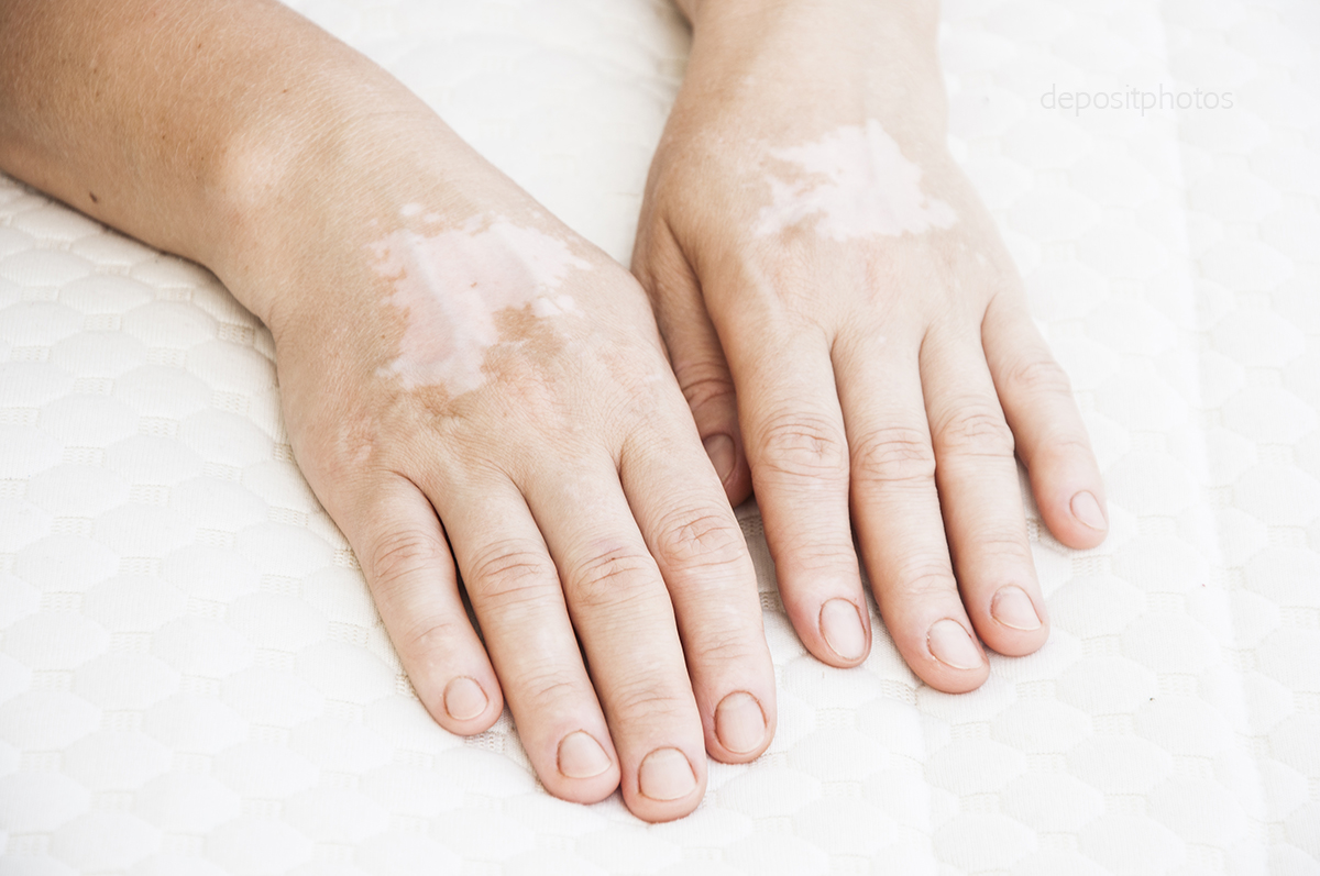 cosas que debes saber del vitiligo 