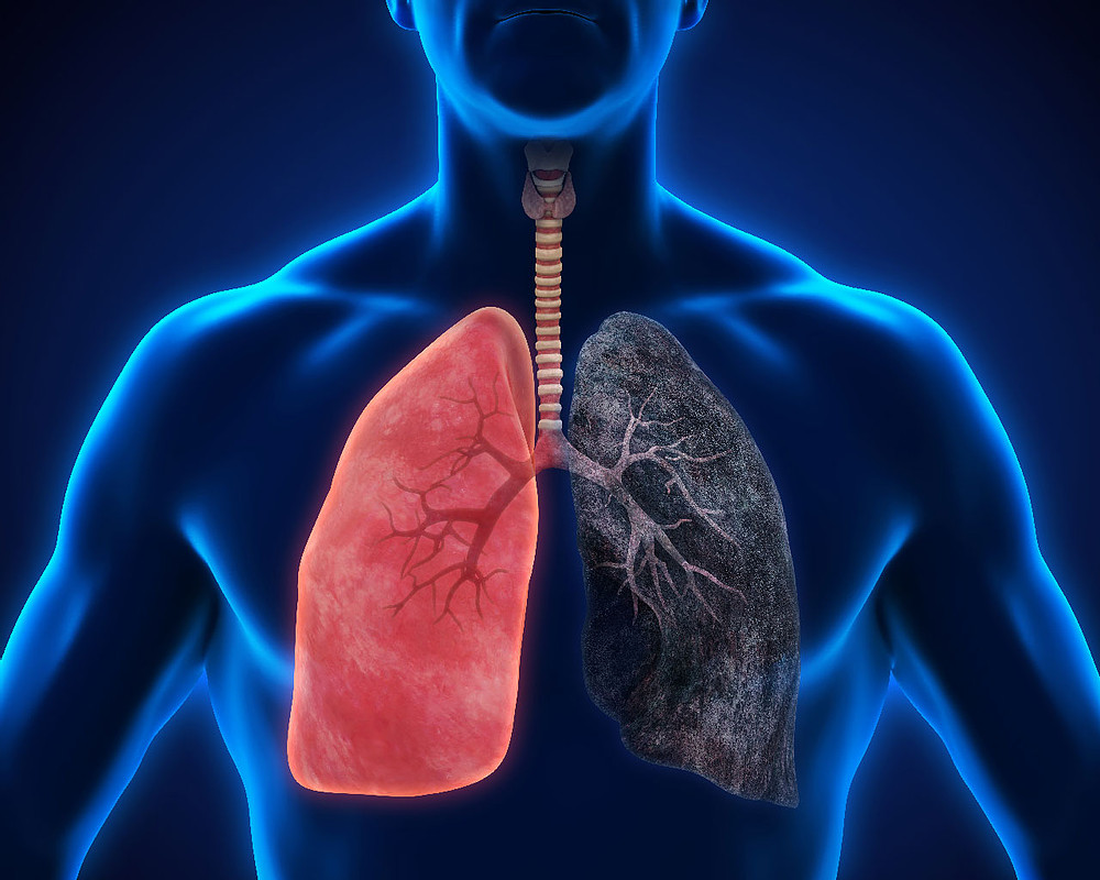Pulmonía bilateral y sus síntomas