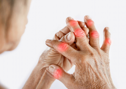 Síntomas de la artritis reumatoide