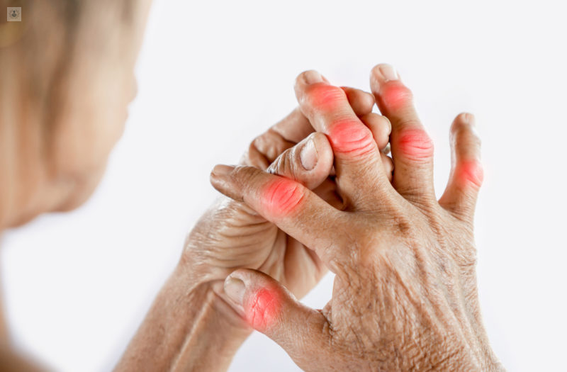 artritis reumatodide