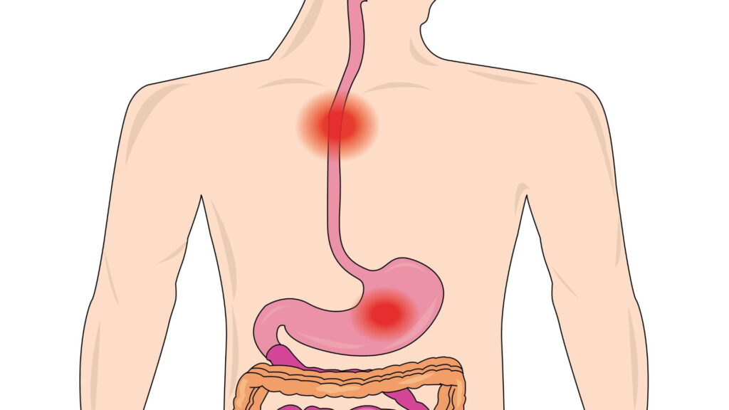 animación esofagitis