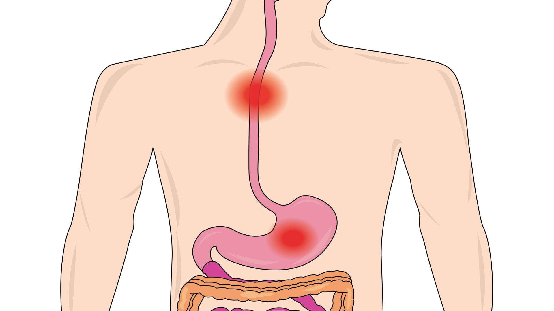 Todo sobre la Esofagitis